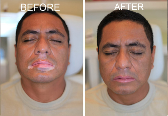 Vitiligo