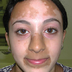 vitiligo_treatment